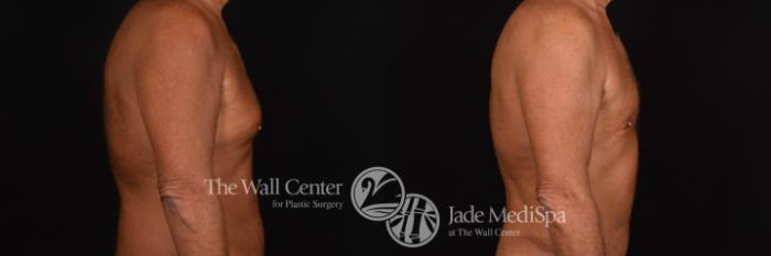Gynecomastia Right Side Photo, Shreveport, Louisiana, The Wall Center for Plastic Surgery, Case 818