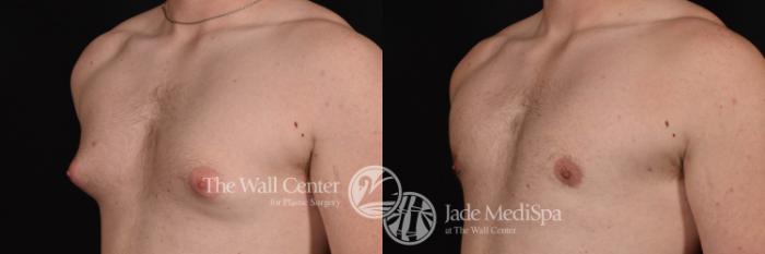 Gynecomastia Left Oblique Photo Close-Up, Shreveport, Louisiana, The Wall Center for Plastic Surgery, Case 275
