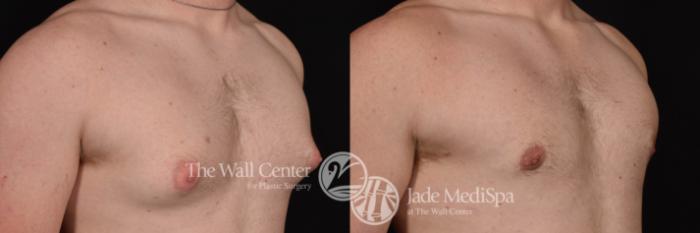 Gynecomastia Right Oblique Photo Close-Up, Shreveport, Louisiana, The Wall Center for Plastic Surgery, Case 275