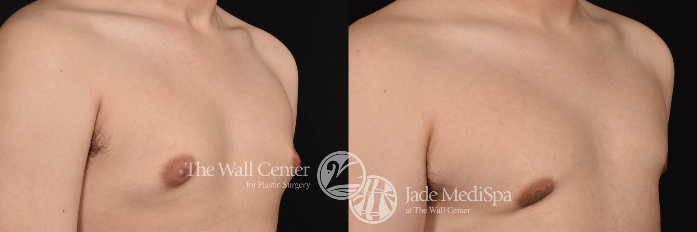 Gynecomastia Right Oblique Photo, Shreveport, Louisiana, The Wall Center for Plastic Surgery, Case 908
