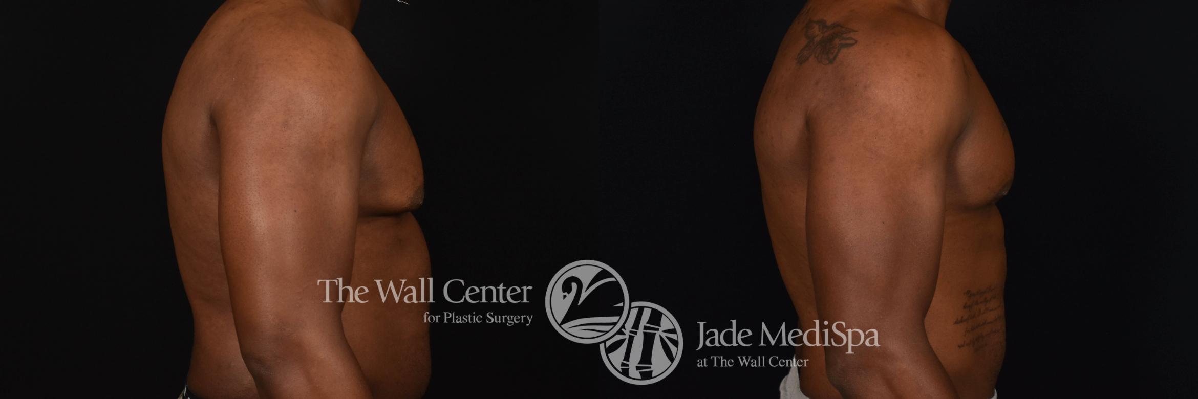 Gynecomastia Right Side Photo, Shreveport, Louisiana, The Wall Center for Plastic Surgery, Case 954