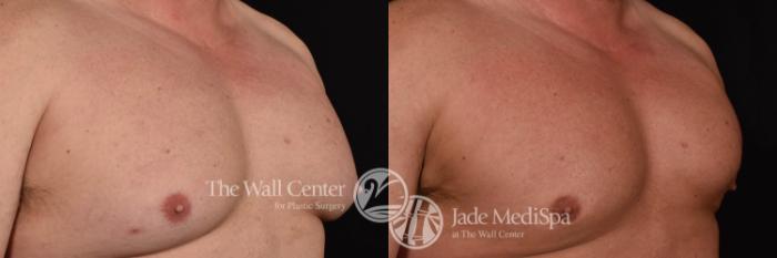 Gynecomastia Right Oblique Close-Up Photo, Shreveport, Louisiana, The Wall Center for Plastic Surgery, Case 969