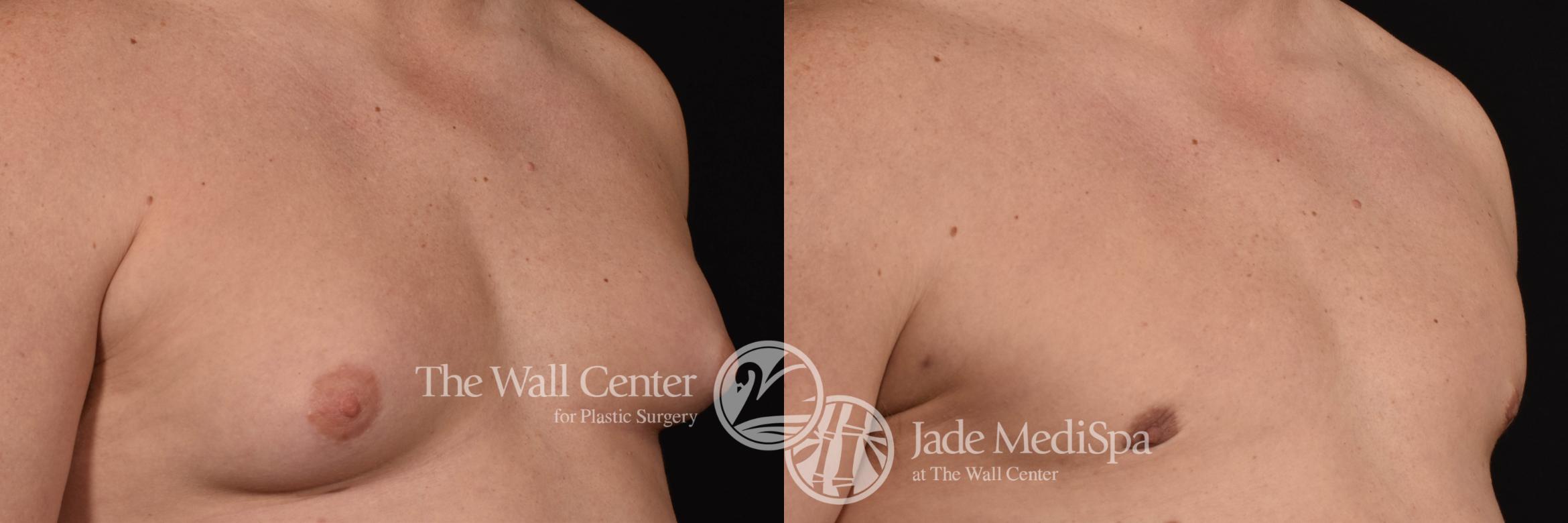 Before & After Male Breast Reduction Case 991 Right Side View in Shreveport, LA
