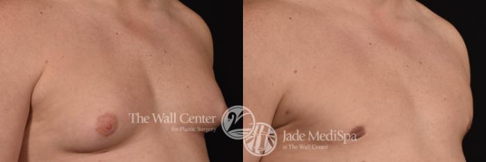 Before & After Male Breast Reduction Case 991 Right Side View in Shreveport, LA