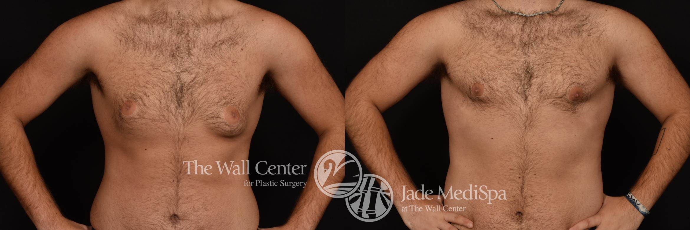 Before & After Male Chest Contouring Case 1236 Front View in Shreveport, LA