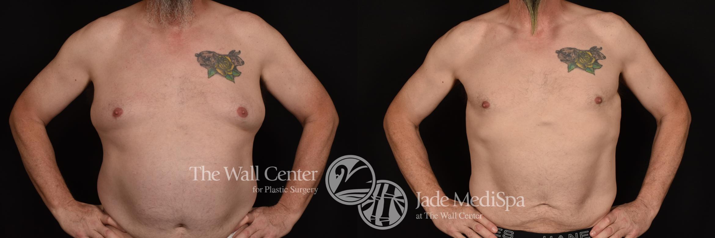 Before & After Male Chest Contouring Case 1244 Front View in Shreveport, LA
