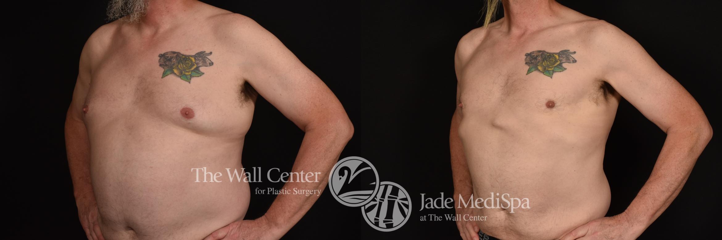 Before & After Male Chest Contouring Case 1244 Left Oblique View in Shreveport, LA