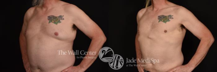 Before & After Male Chest Contouring Case 1244 Left Oblique View in Shreveport, LA