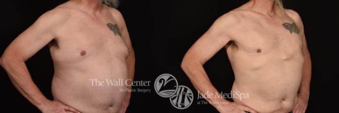 Before & After Male Chest Contouring Case 1244 Right Oblique View in Shreveport, LA
