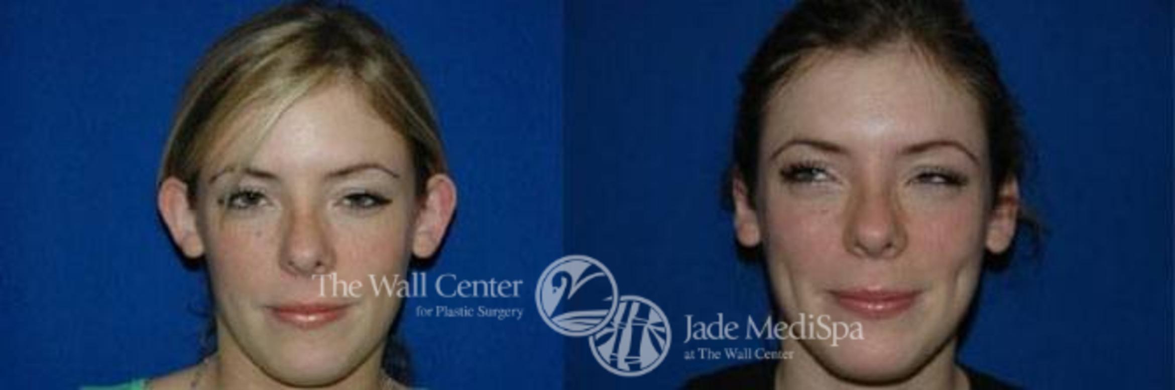 Before & After Otoplasty Case 189 View #1 View in Shreveport, LA