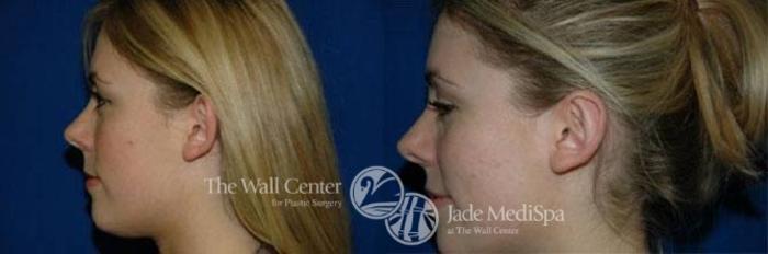 Before & After Otoplasty Case 189 View #2 View in Shreveport, LA