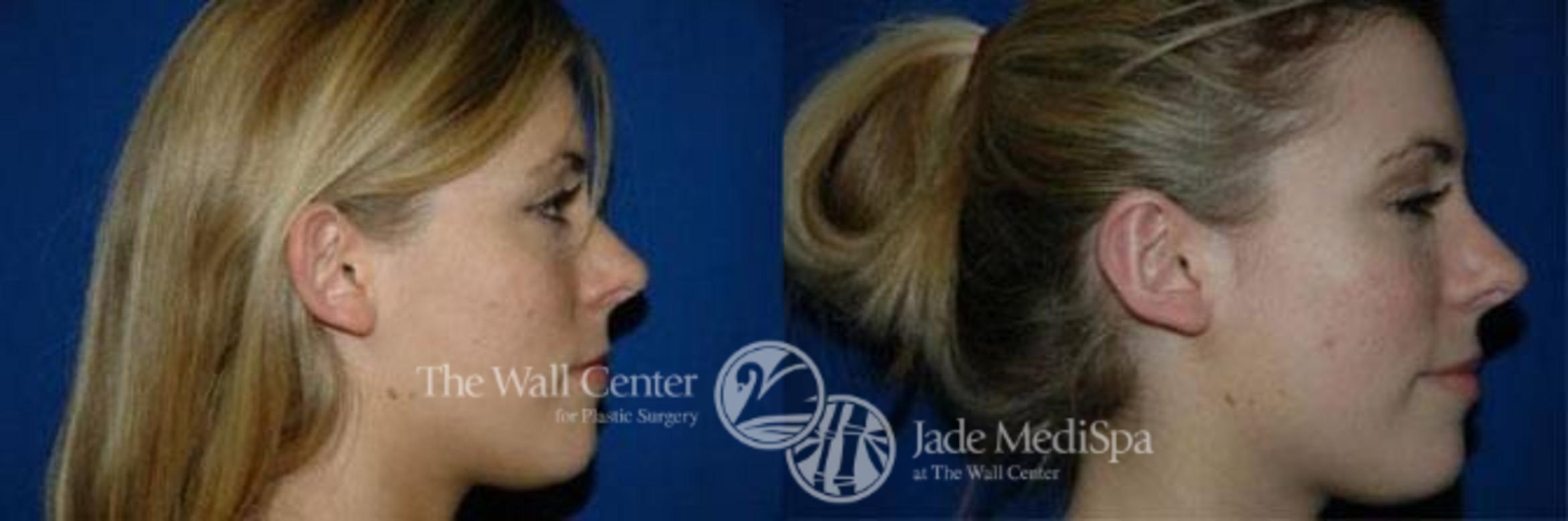 Before & After Otoplasty Case 189 View #3 View in Shreveport, LA