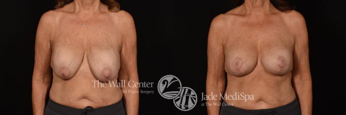 Before & After Redo Surgery/Problem Cases Case 1078 Front View in Shreveport, LA