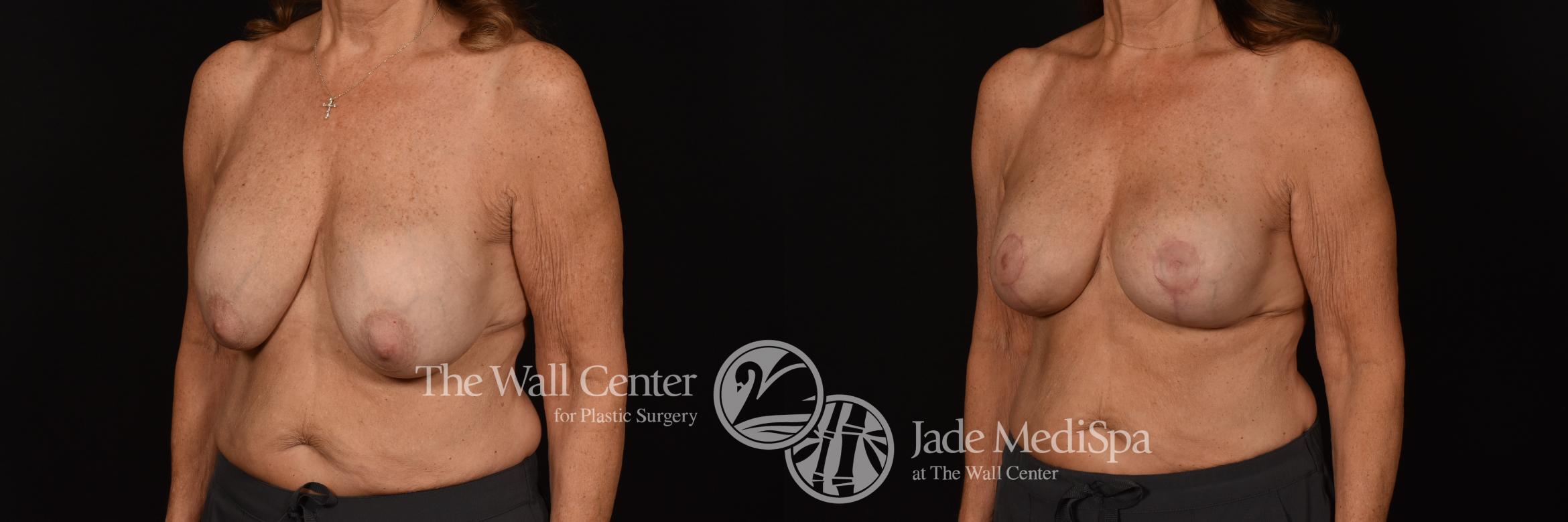 Before & After Redo Surgery/Problem Cases Case 1078 Left Oblique View in Shreveport, LA