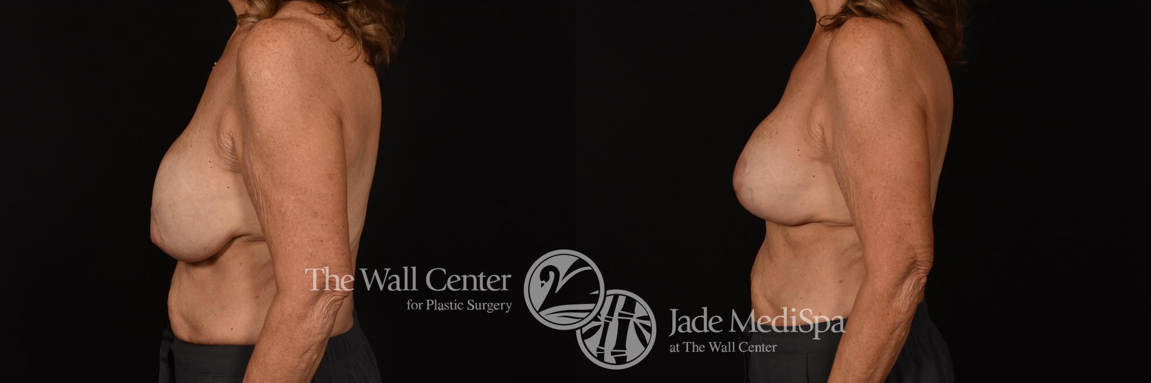 Before & After Redo Surgery/Problem Cases Case 1078 Left Side View in Shreveport, LA