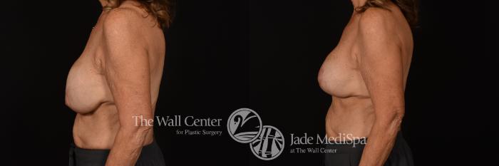 Before & After Redo Surgery/Problem Cases Case 1078 Left Side View in Shreveport, LA