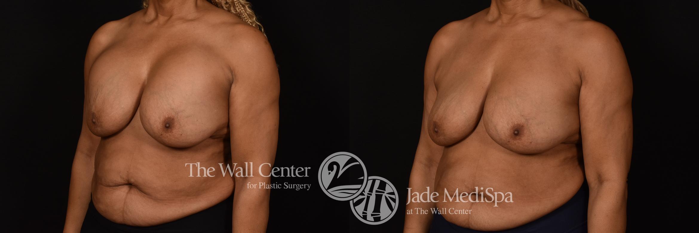 Before & After Redo Surgery/Problem Cases Case 1081 Left Oblique View in Shreveport, LA