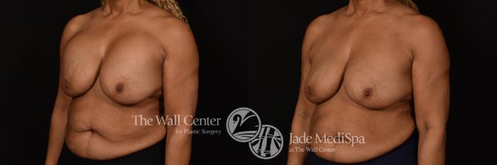 Before & After Redo Surgery/Problem Cases Case 1081 Left Oblique View in Shreveport, LA