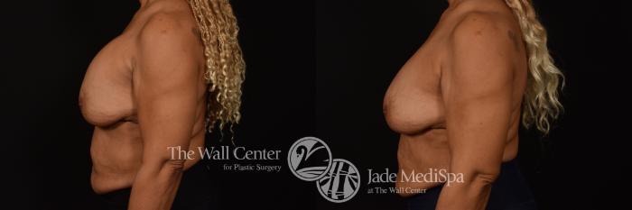 Before & After Redo Surgery/Problem Cases Case 1081 Left Side View in Shreveport, LA