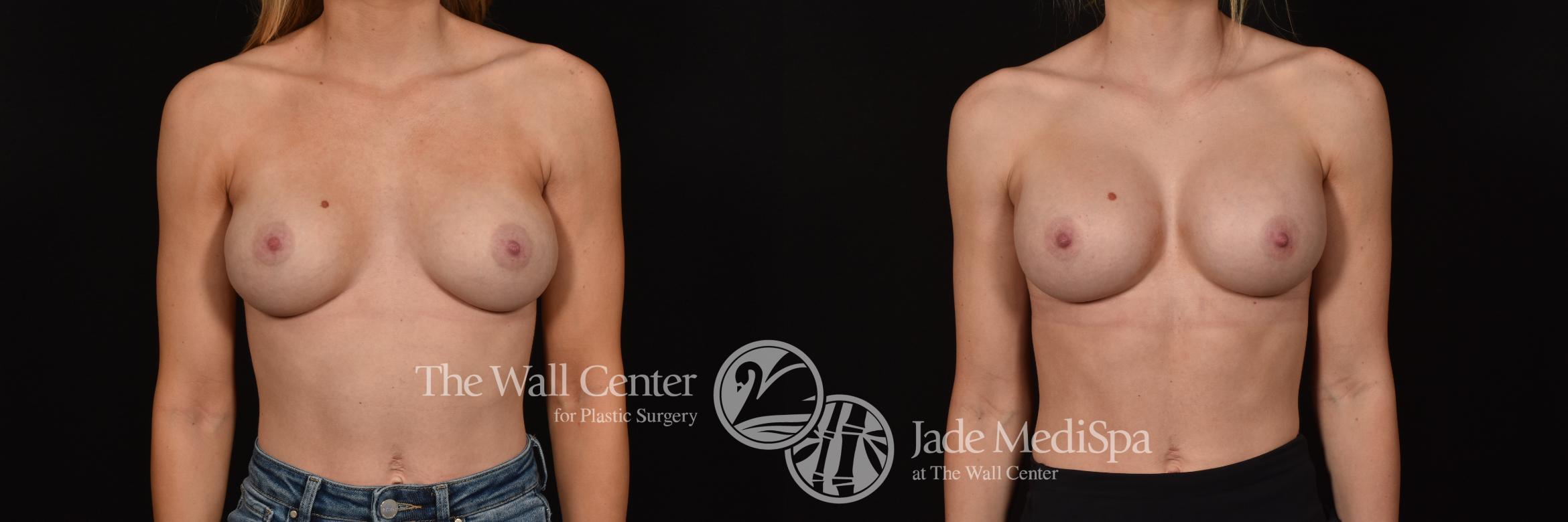 Before & After Redo Surgery/Problem Cases Case 1117 Front View in Shreveport, LA
