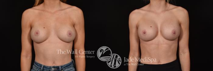 Before & After Redo Surgery/Problem Cases Case 1117 Front View in Shreveport, LA