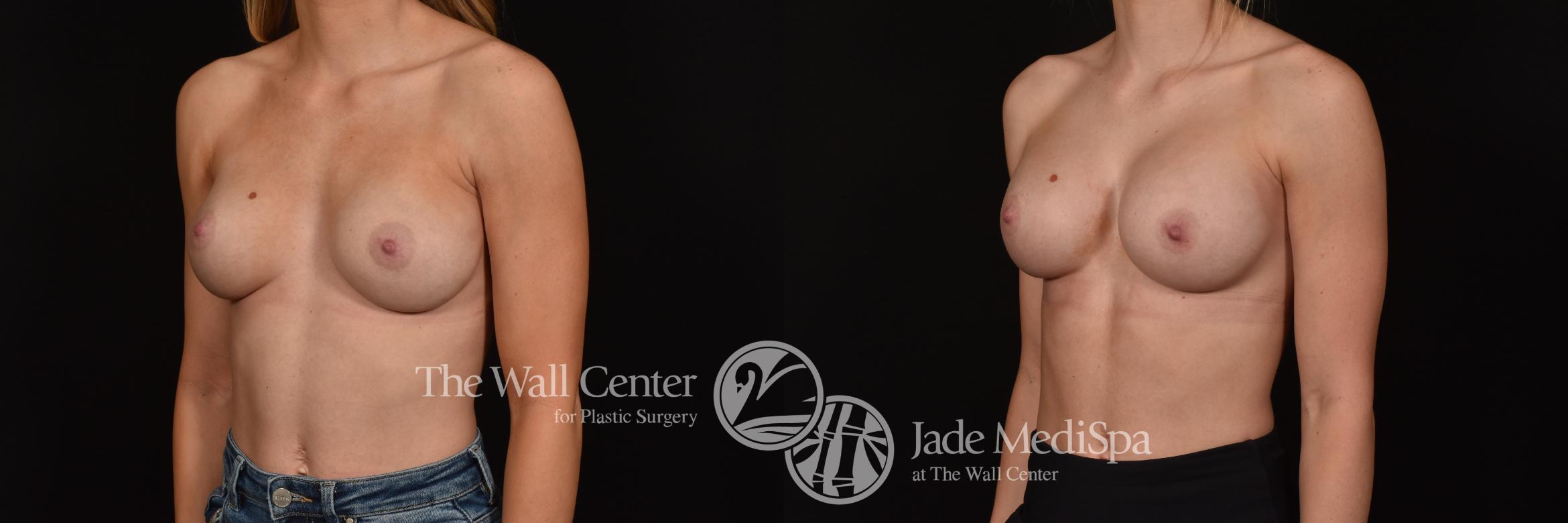 Before & After Redo Surgery/Problem Cases Case 1117 Left Oblique View in Shreveport, LA