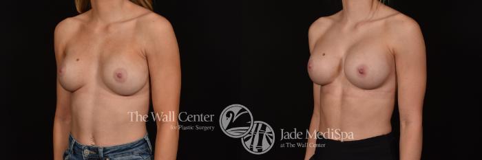 Before & After Redo Surgery/Problem Cases Case 1117 Left Oblique View in Shreveport, LA