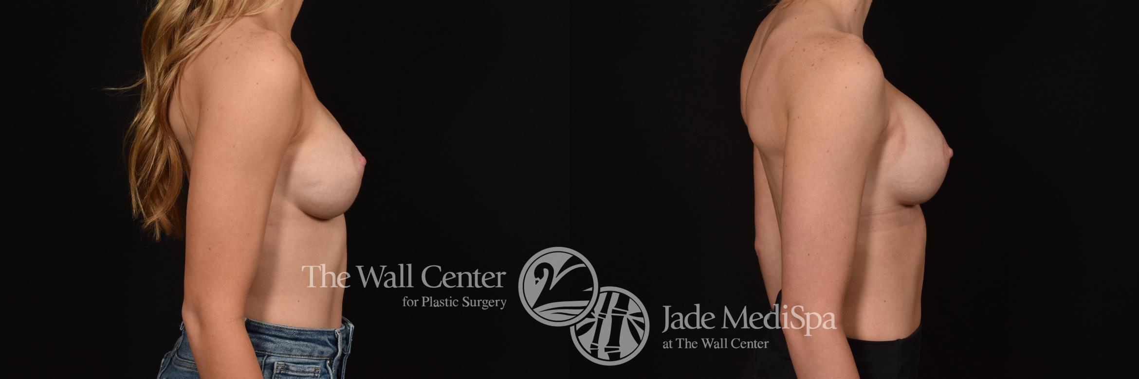 Before & After Redo Surgery/Problem Cases Case 1117 Right Side View in Shreveport, LA