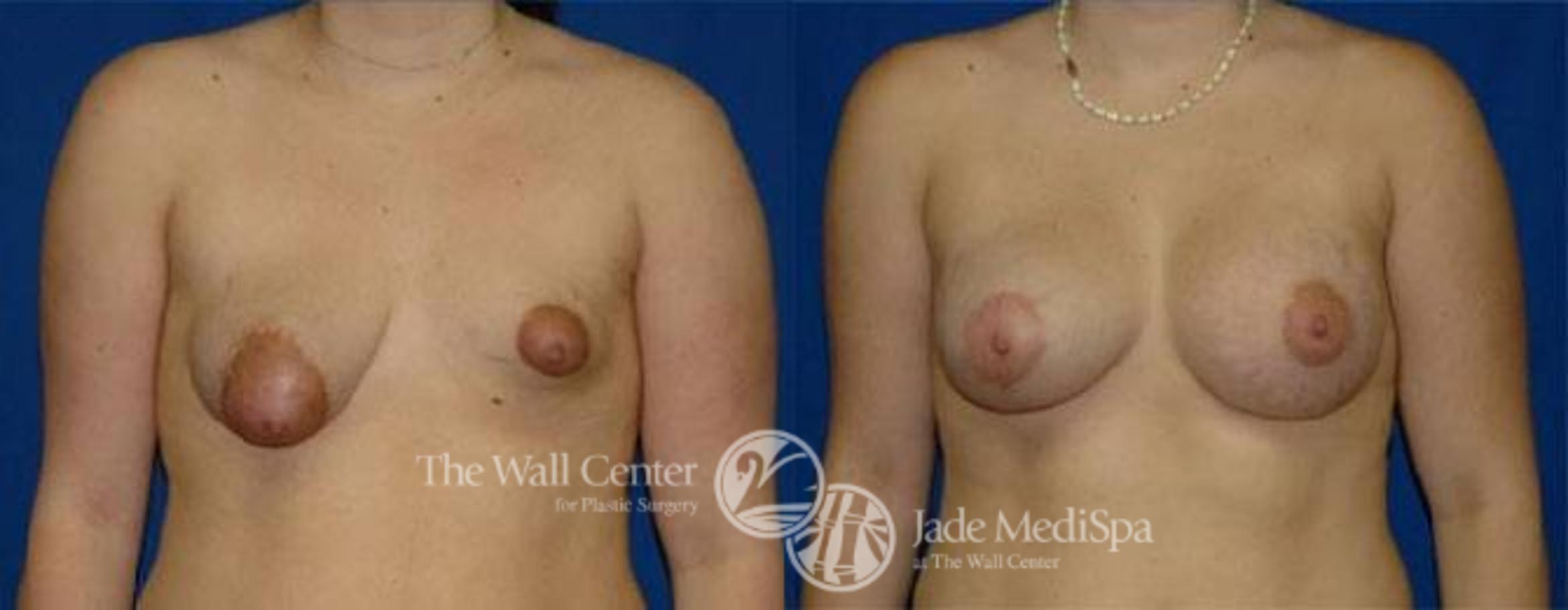 Before & After Breast Augmentation with Lift Case 135 View #1 View in Shreveport, LA