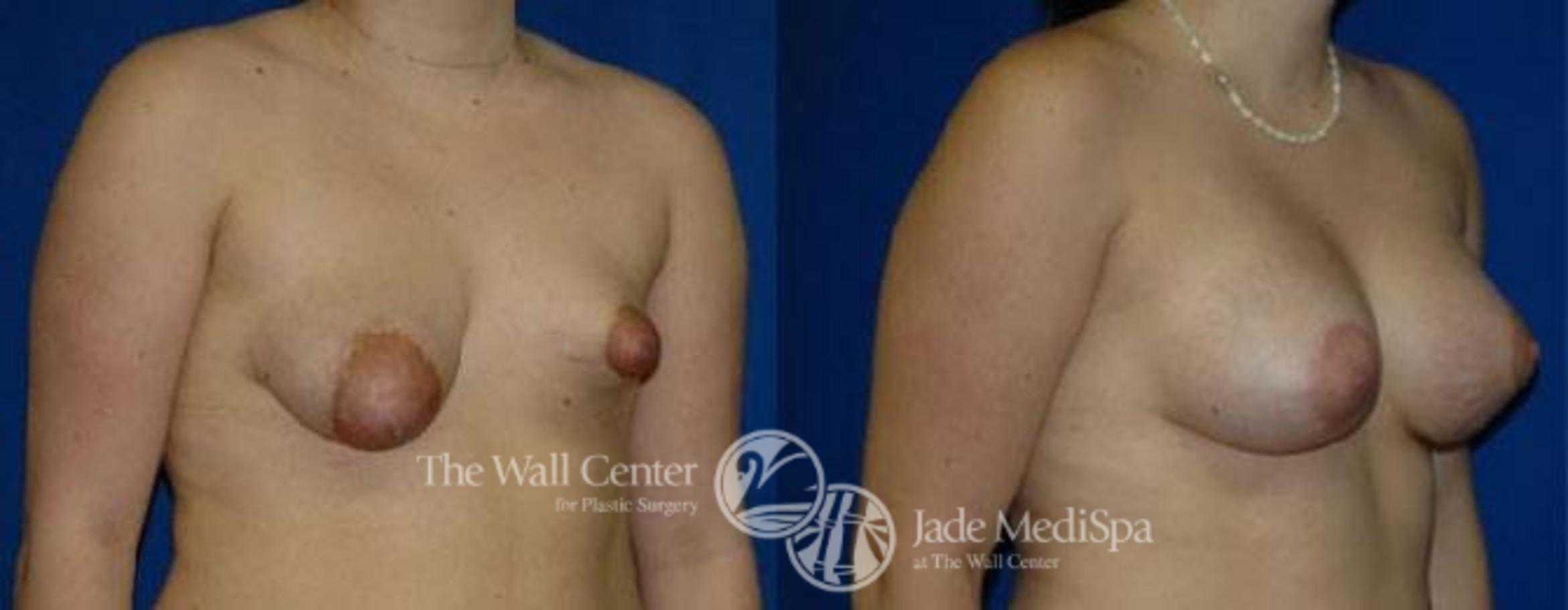 Before & After Breast Augmentation with Lift Case 135 View #2 View in Shreveport, LA