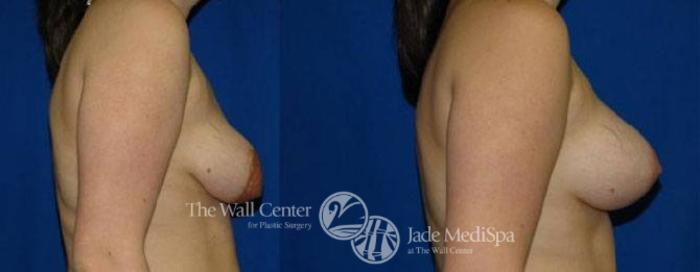 Before & After Breast Augmentation with Lift Case 135 View #3 View in Shreveport, LA
