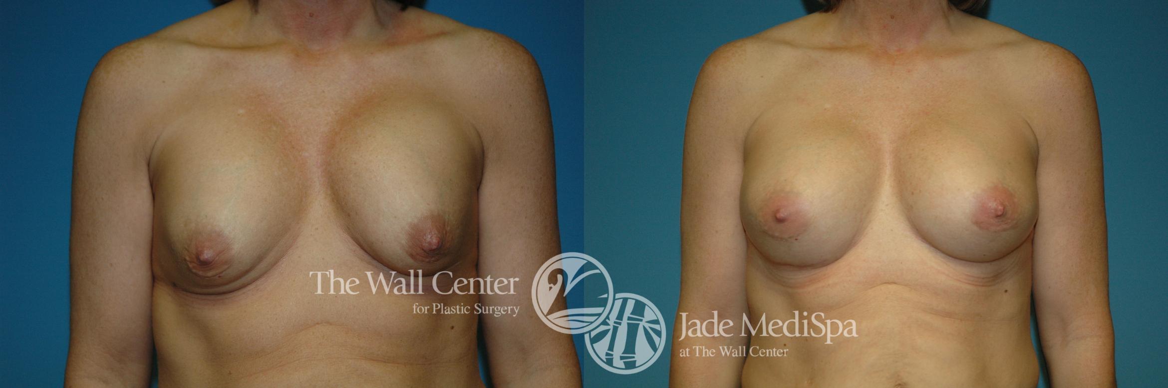 Before & After Redo Surgery/Problem Cases Case 208 View #1 View in Shreveport, LA