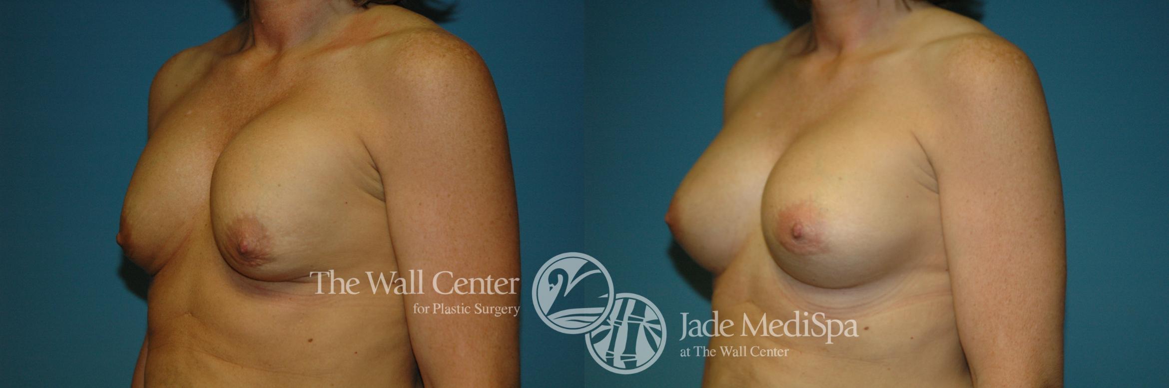 Before & After Redo Surgery/Problem Cases Case 208 View #2 View in Shreveport, LA