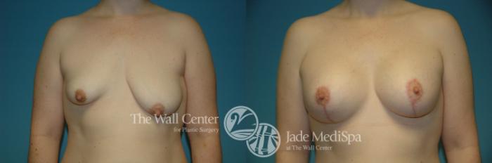 Before & After Redo Surgery/Problem Cases Case 211 View #1 View in Shreveport, LA