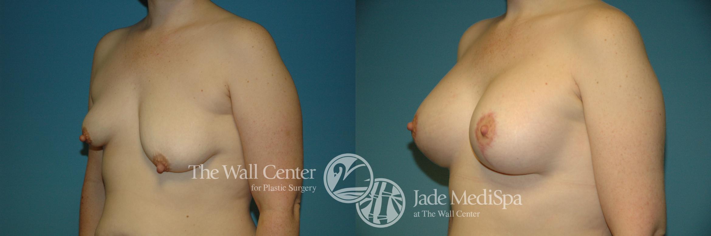 Before & After Breast Augmentation with Lift Case 211 View #2 View in Shreveport, LA