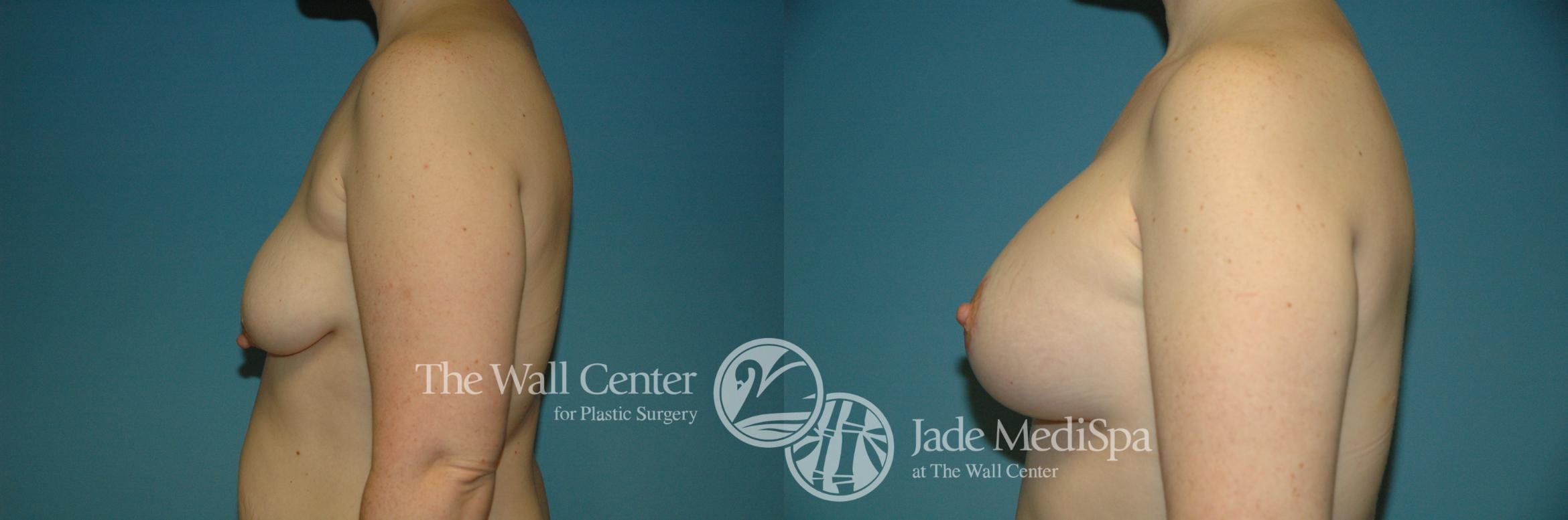 Before & After Redo Surgery/Problem Cases Case 211 View #3 View in Shreveport, LA
