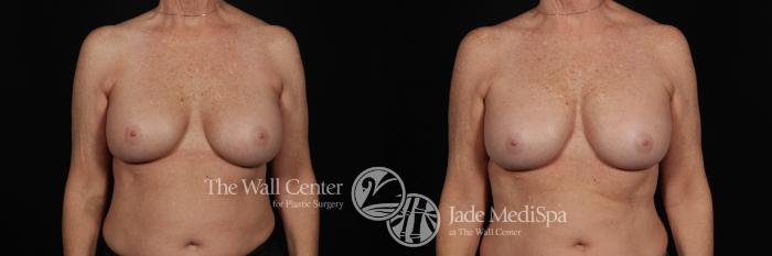 Before & After Redo Surgery/Problem Cases Case 507 View #2 View in Shreveport, LA