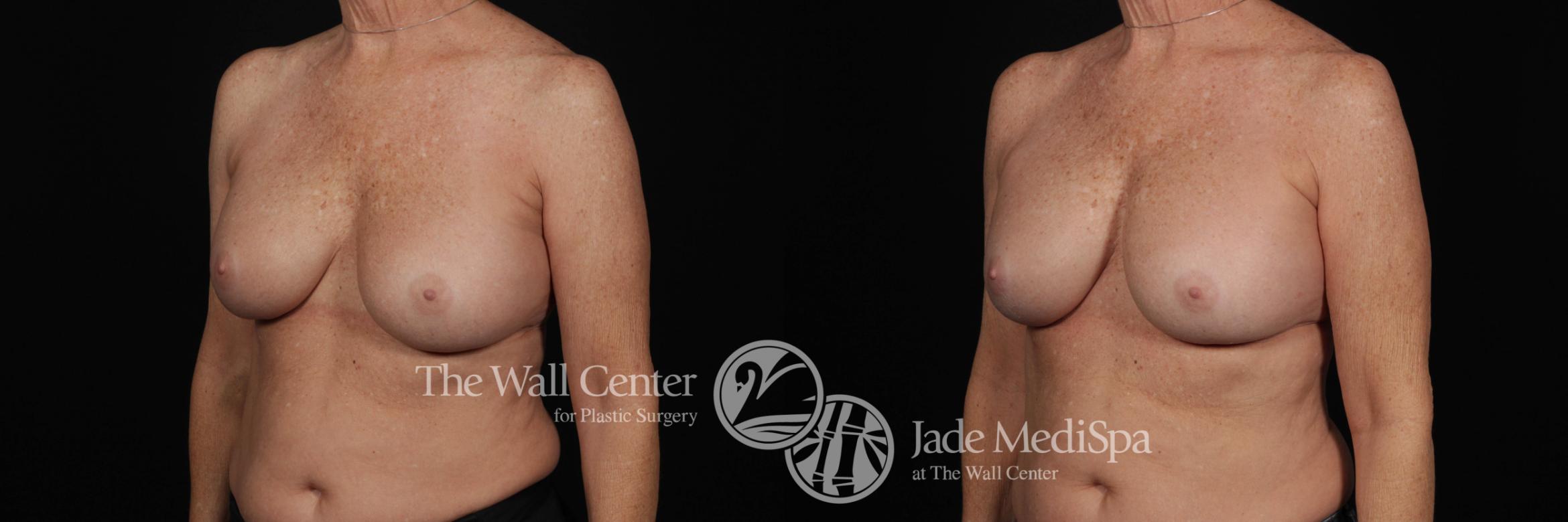 Before & After Redo Surgery/Problem Cases Case 507 View #3 View in Shreveport, LA