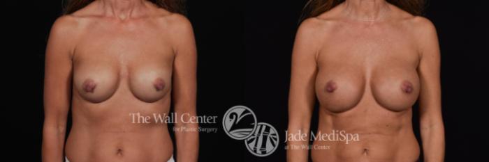 Before & After Redo Surgery/Problem Cases Case 560 View #1 View in Shreveport, LA