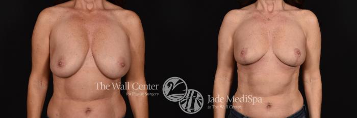 Before & After Redo Surgery/Problem Cases Case 605 View #1 View in Shreveport, LA