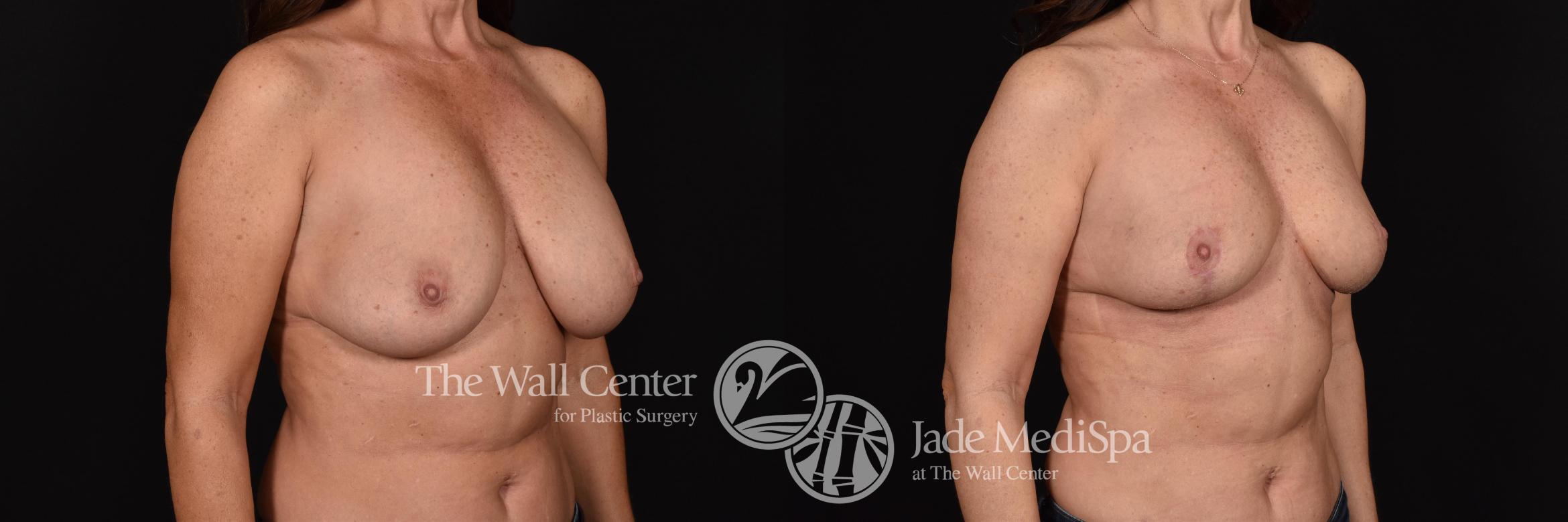 Before & After Redo Surgery/Problem Cases Case 605 View #2 View in Shreveport, LA