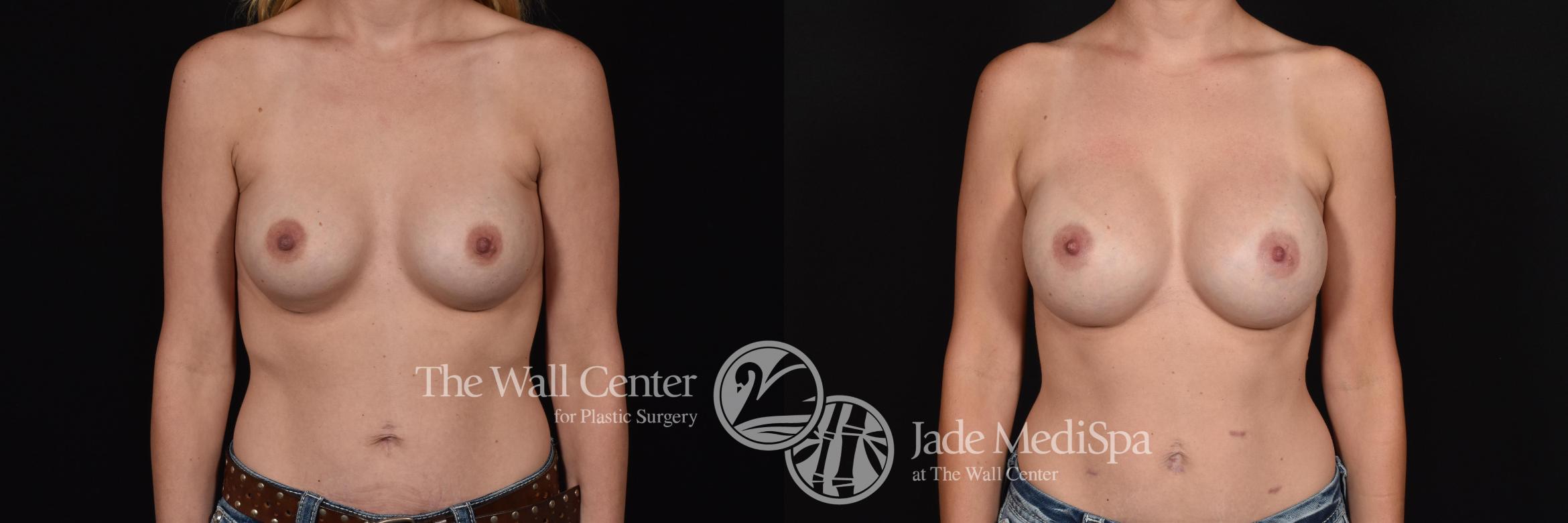 Before & After Redo Surgery/Problem Cases Case 631 VIEW #1 View in Shreveport, LA