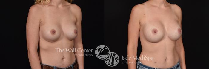 Before & After Redo Surgery/Problem Cases Case 631 VIEW #2 View in Shreveport, LA