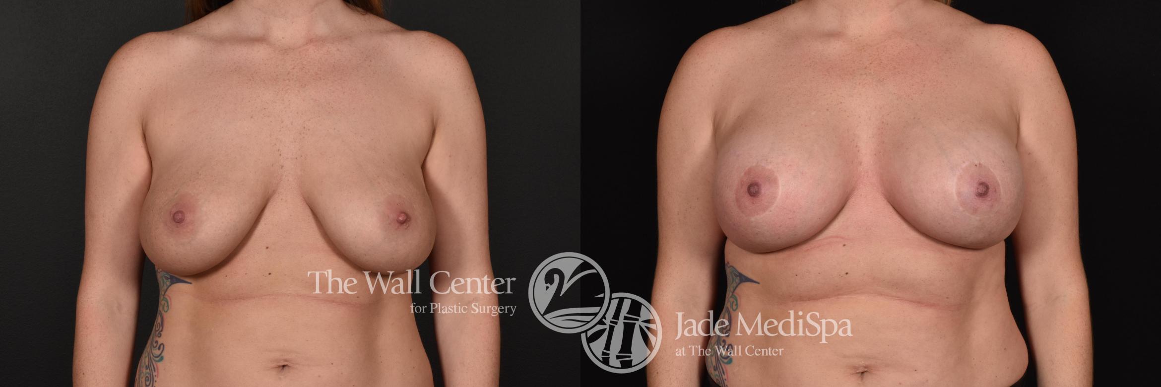 Before & After Redo Surgery/Problem Cases Case 632 VIEW #1 View in Shreveport, LA