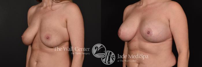 Before & After Redo Surgery/Problem Cases Case 632 VIEW #2 View in Shreveport, LA