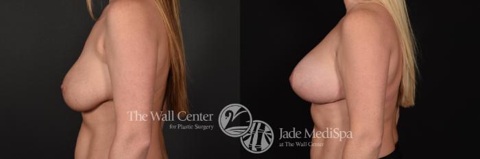 Before & After Redo Surgery/Problem Cases Case 632 VIEW #3 View in Shreveport, LA