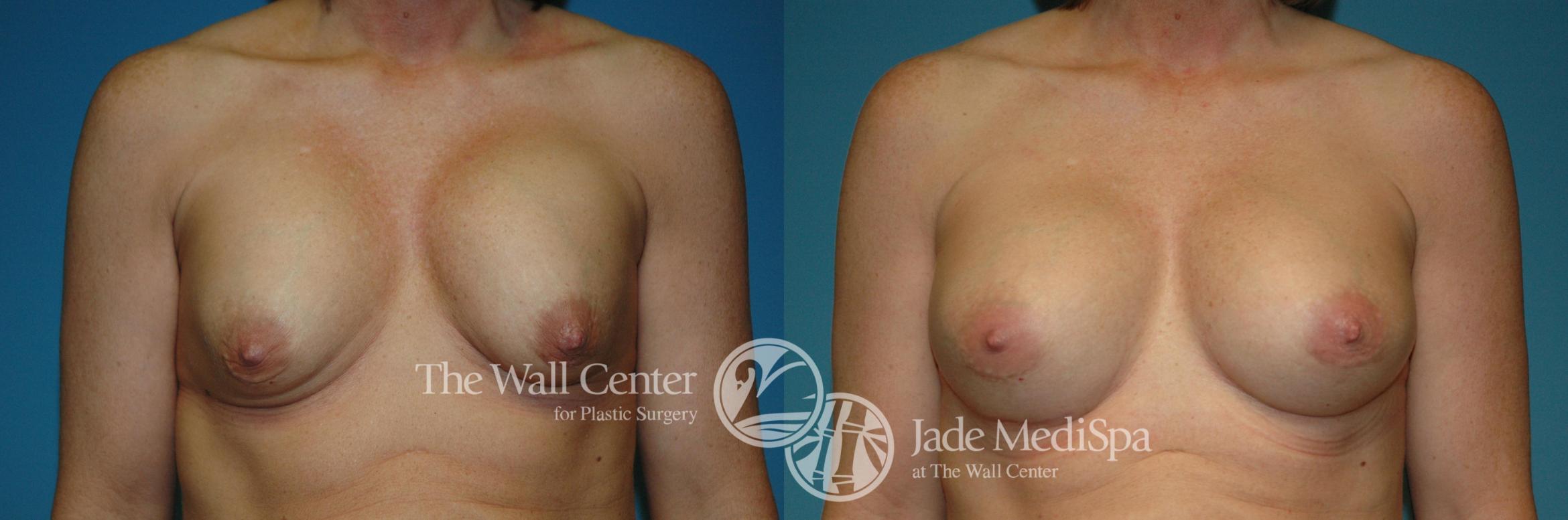 Before & After Redo Surgery/Problem Cases Case 645 VIEW #1 View in Shreveport, LA