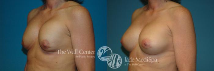 Before & After Redo Surgery/Problem Cases Case 645 VIEW #2 View in Shreveport, LA