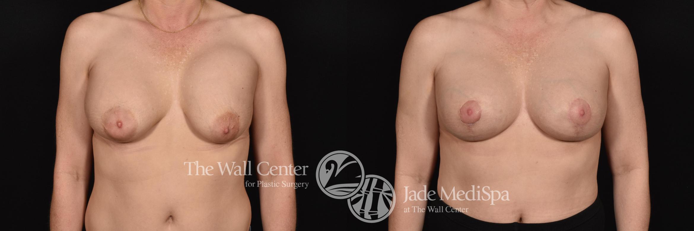 Before & After Breast Lift Case 651 VIEW #1 View in Shreveport, LA