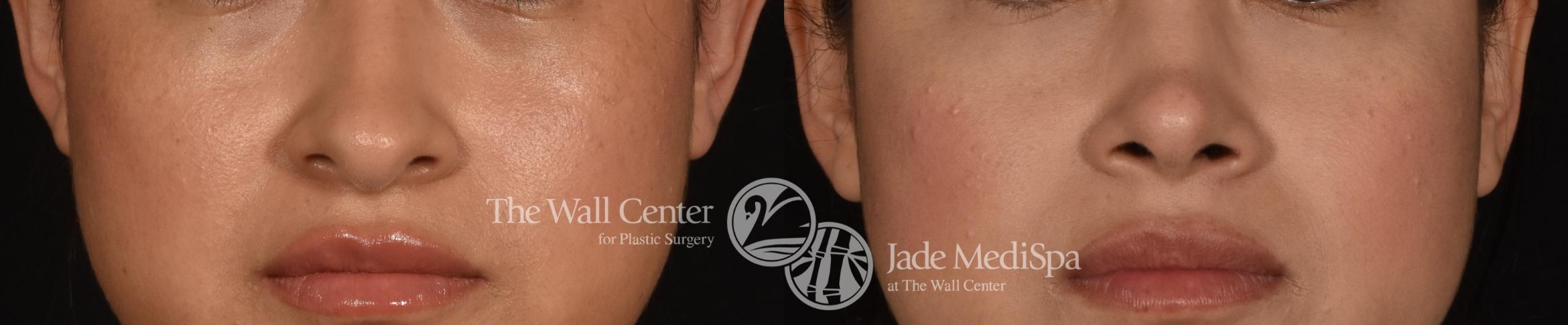 Before & After Rhinoplasty Case 1184 Front View in Shreveport, LA